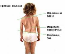 Школьные портфели вызывают болезни позвоночника и нервной системы. Школьные портфели вызывают болезни позвоночника и нервной системы.